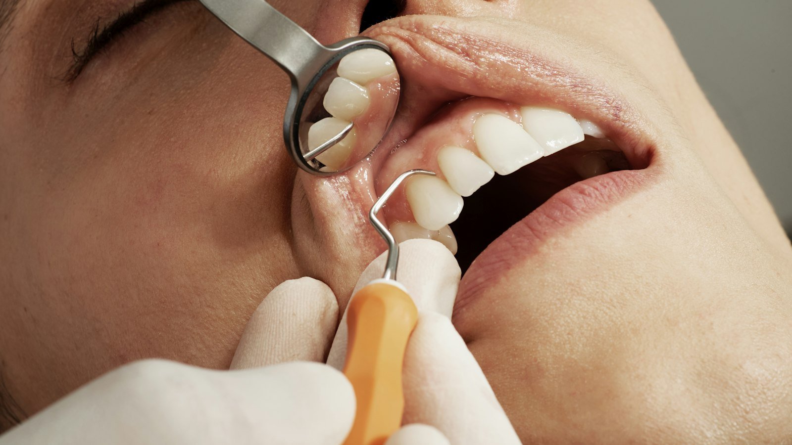 Veneers.
